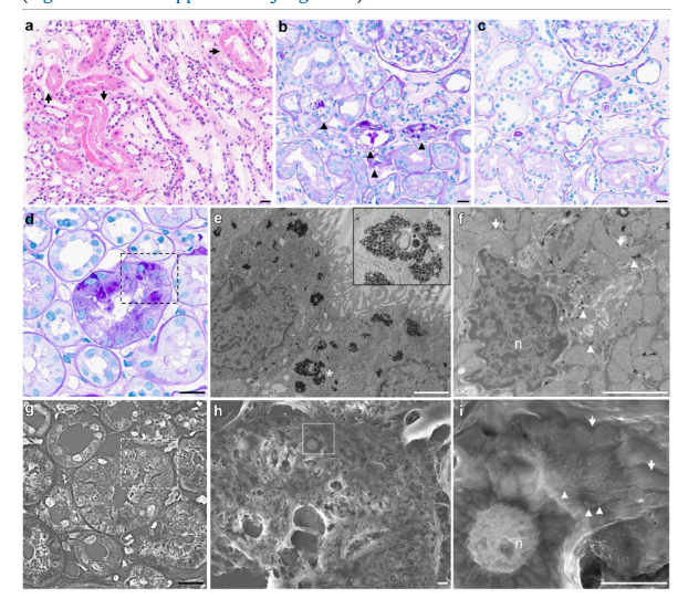 Acute Tubular Injury and Fanconi Syndrome Associated With Red Yeast Rice Supplement（＠ScienceDirect）